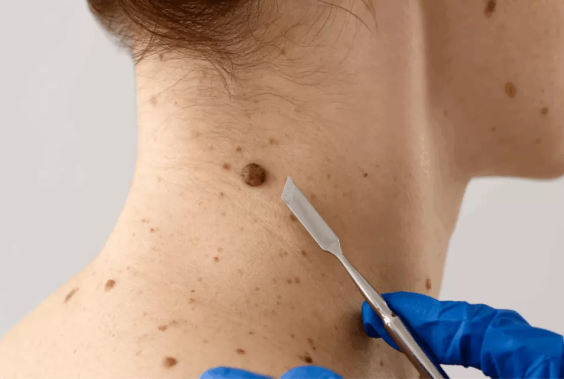 Farmacêuticas anunciam sucesso de vacina experimental contra recidiva do melanoma